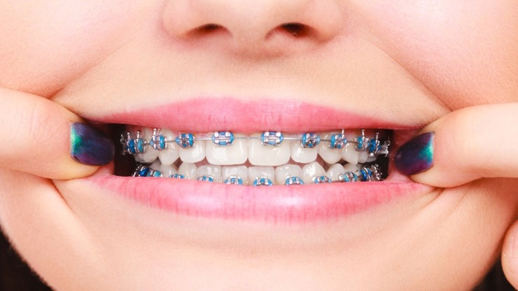 Teeth Braces