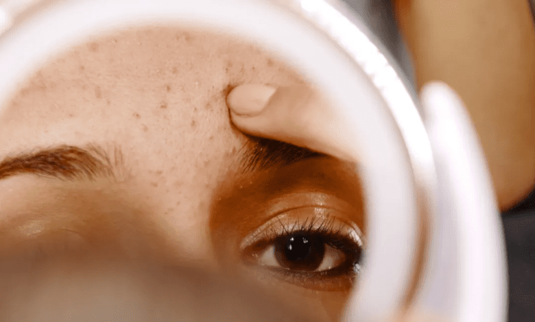 blackheads removal