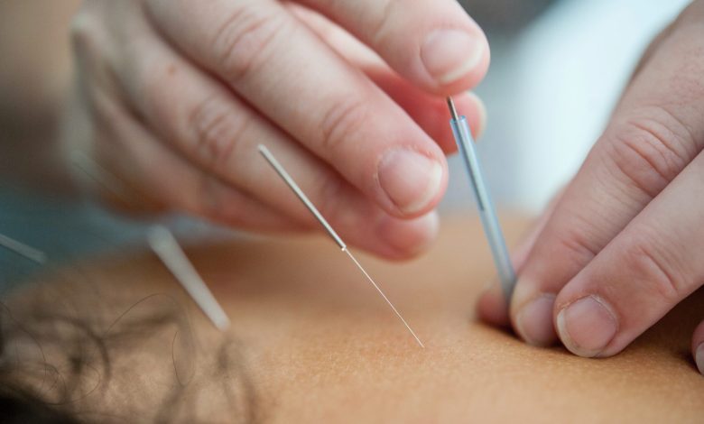 Acupuncture in Virginia