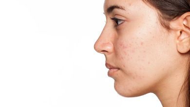 IPL Acne Treatment for skin