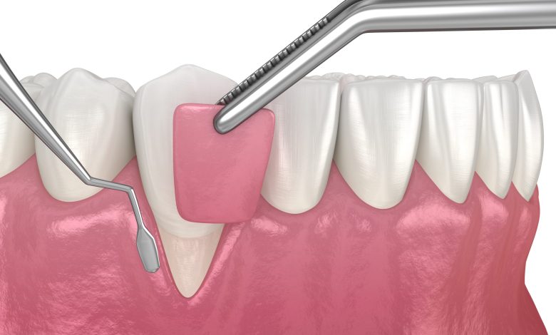 gum recession treatment