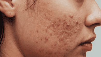 Facing Up to Acne