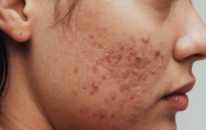 Facing Up to Acne