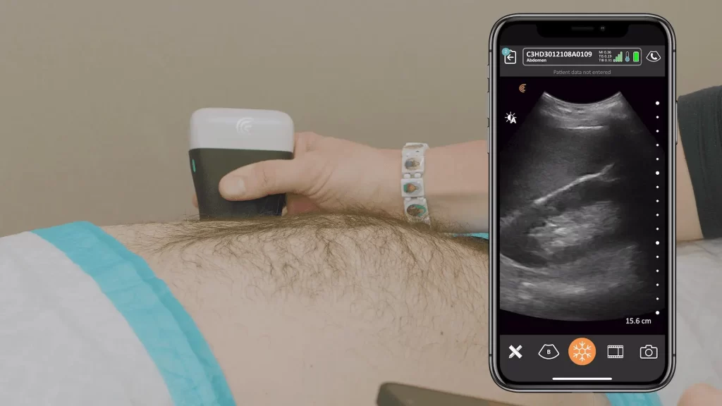 Wireless Ultrasound Scanners