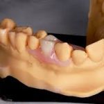 top valplast partial dentures in China-HINNO-Dental Lab