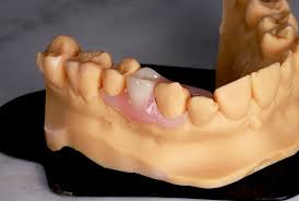 top valplast partial dentures in China-HINNO-Dental Lab