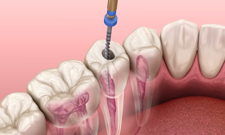 root canal treatment