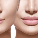 lip injections