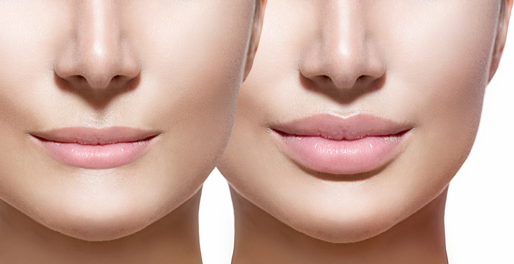 lip injections